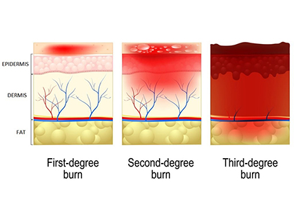 燒傷深度示意圖